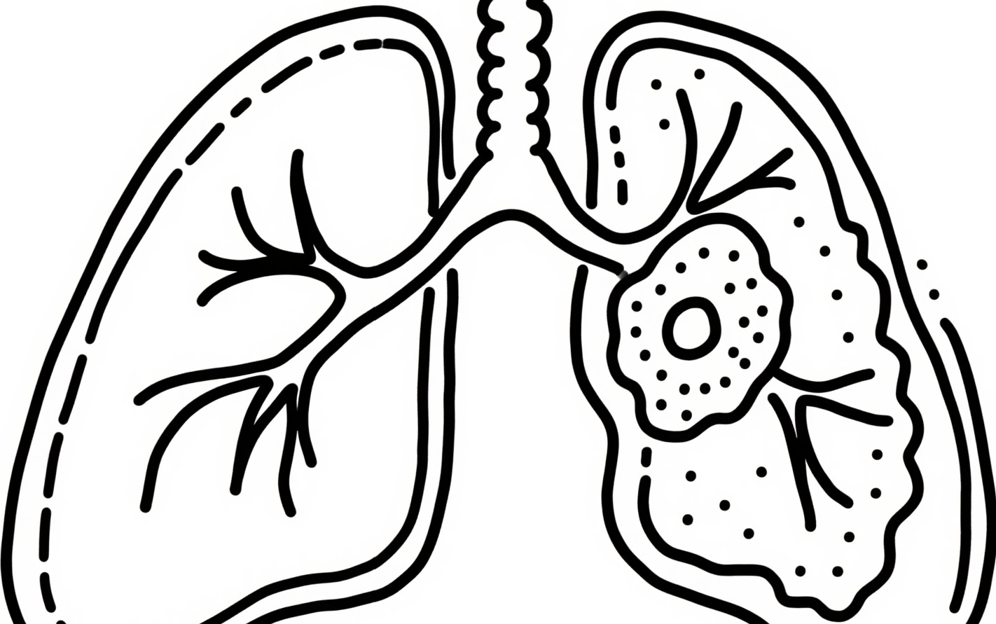 得了肺结节怎么治